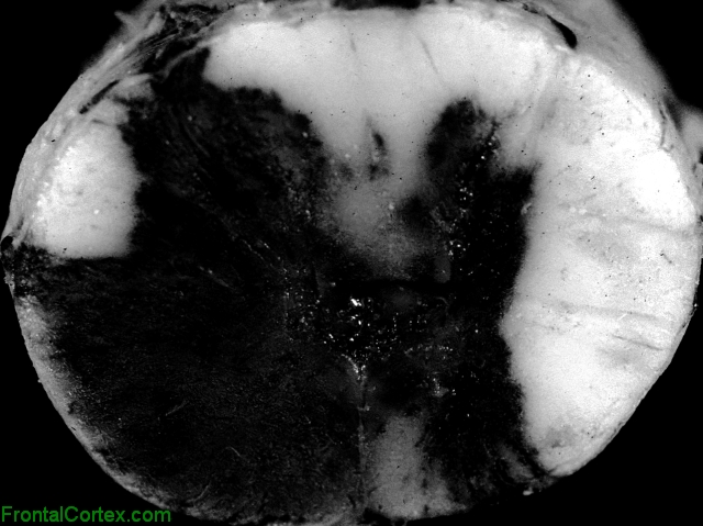 Intramedullary spinal cord hemorrhage, transverse section through thoracic spinal cord.